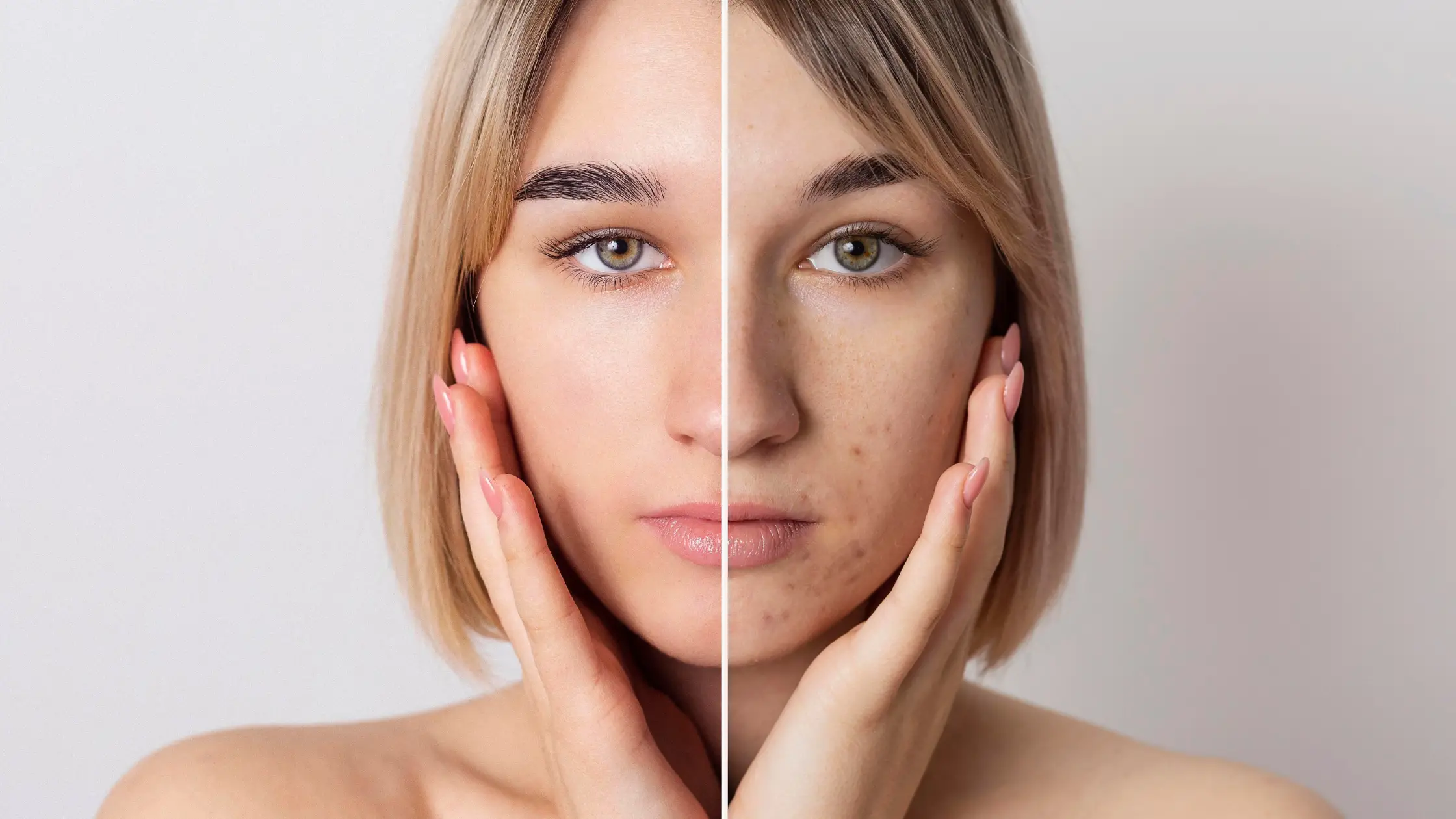 Acne Scars, Open Pores & Uneven Skin Texture Treatments That Actually Work